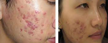 Lựa chọn phương pháp phù hợp để trị sẹo thâm một cách hiệu quả