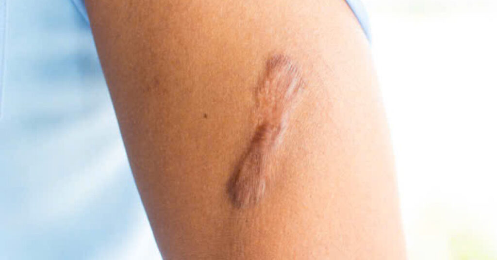 Sẹo để lại trên da gây mất thẩm mỹ