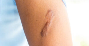 Sẹo để lại trên da gây mất thẩm mỹ