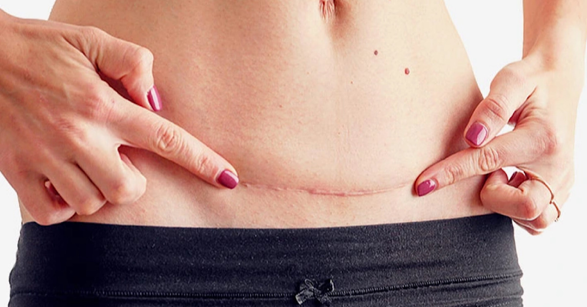 Điều trị sẹo lồi sau phẫu thuật sinh con một cách hiệu quả an toàn