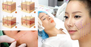 Bật Mí 4 Công Dụng “Đỉnh Cao” Của Chỉ FIGO Giúp Da Trẻ Hóa Tự Nhiên Không Cần Phẫu Thuật