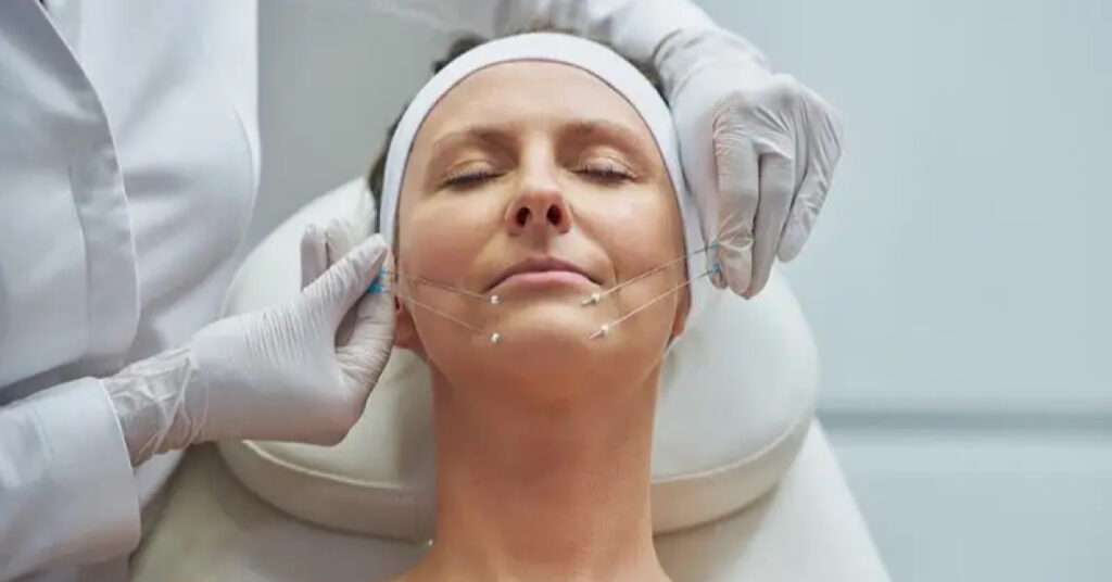 4 điều cần tuyệt đối tránh sau khi cấy chỉ FIGO