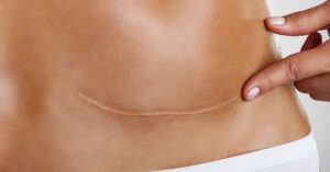 Sẹo sau phẫu thuật - “nỗi tự ti” của nhiều người