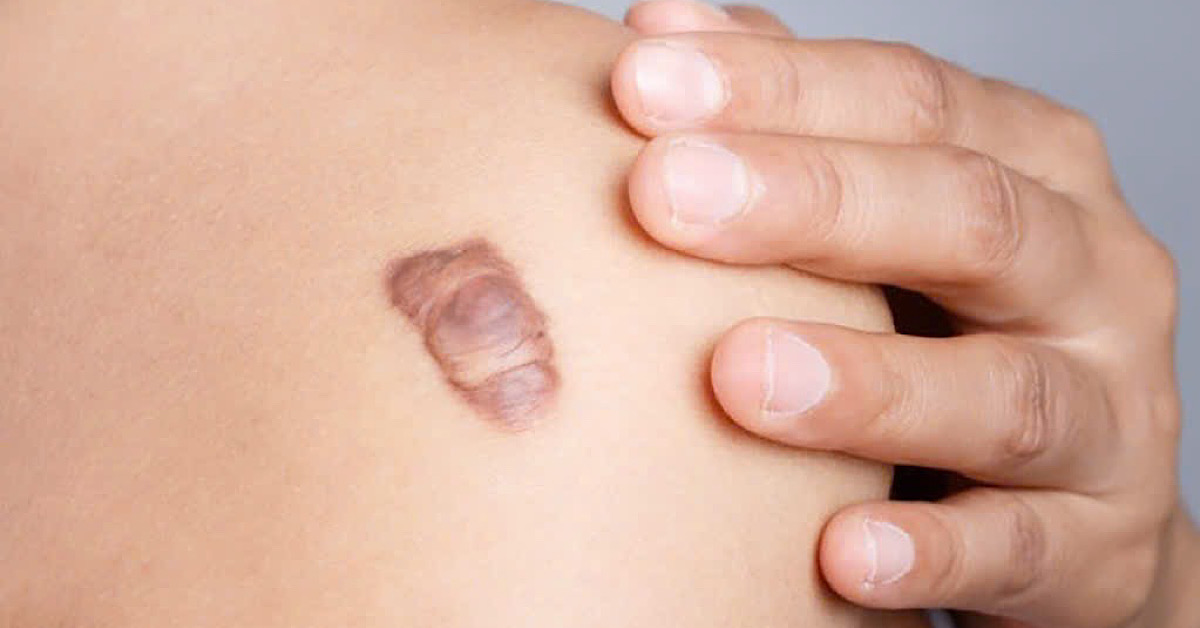 “Cơ địa” là một trong những nguyên nhân 