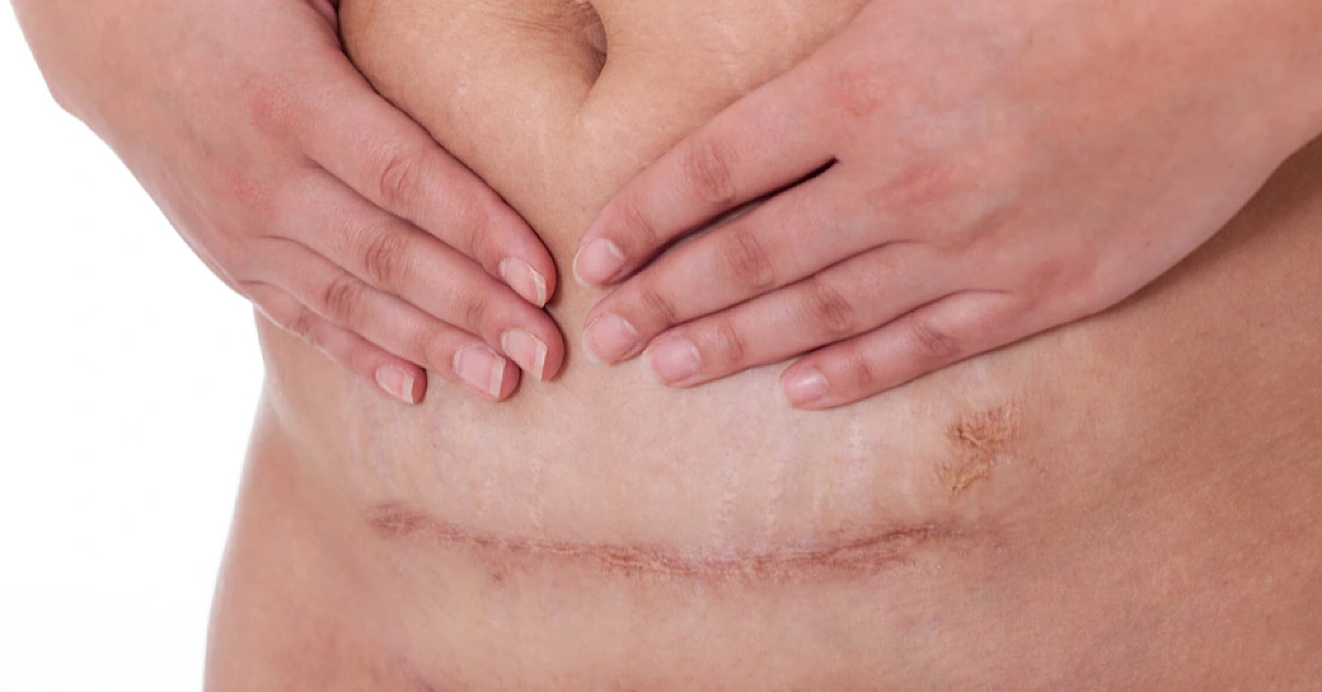 Lựa chọn phương pháp trị sẹo phù hợp để xoá tan nỗi lo sẹo sau phẫu thuật