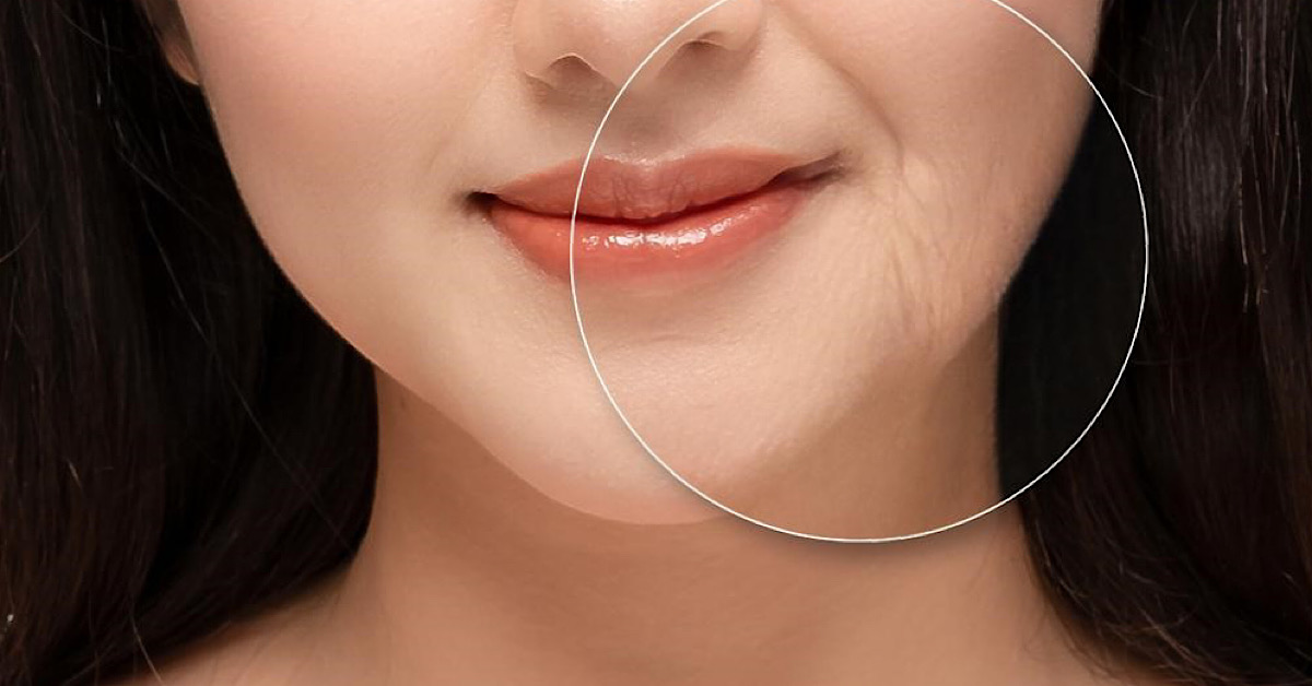 Nếp nhăn động bắt đầu trở thành nếp nhăn tĩnh