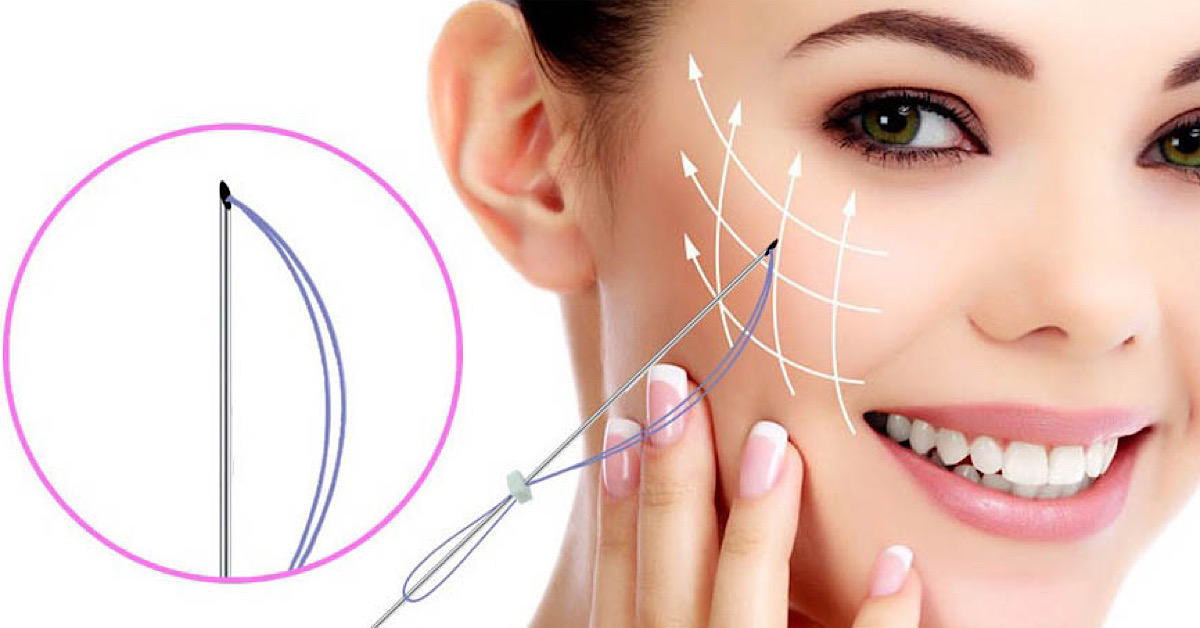 Chỉ FIGO là dòng chỉ sinh học thẩm mỹ chất lượng cao