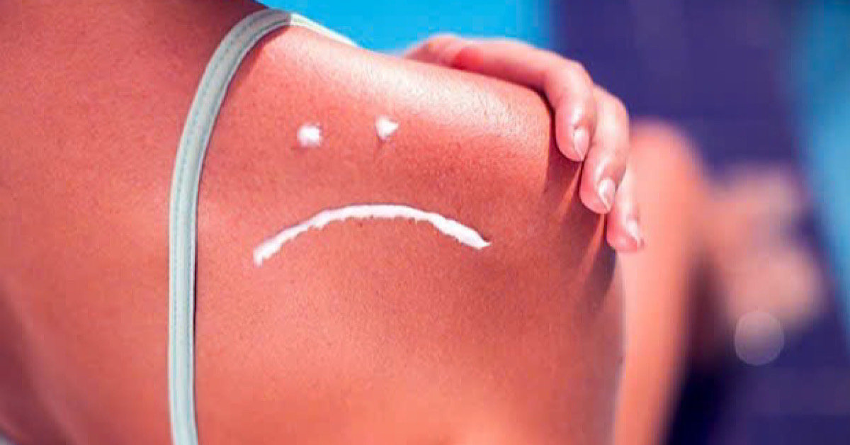 Ánh nắng mặt trời - “kẻ thù số một” của các loại sẹo