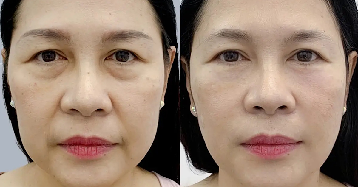 Kết quả thấy rõ sau cấy chỉ FIGO nếu chăm sóc đúng cách