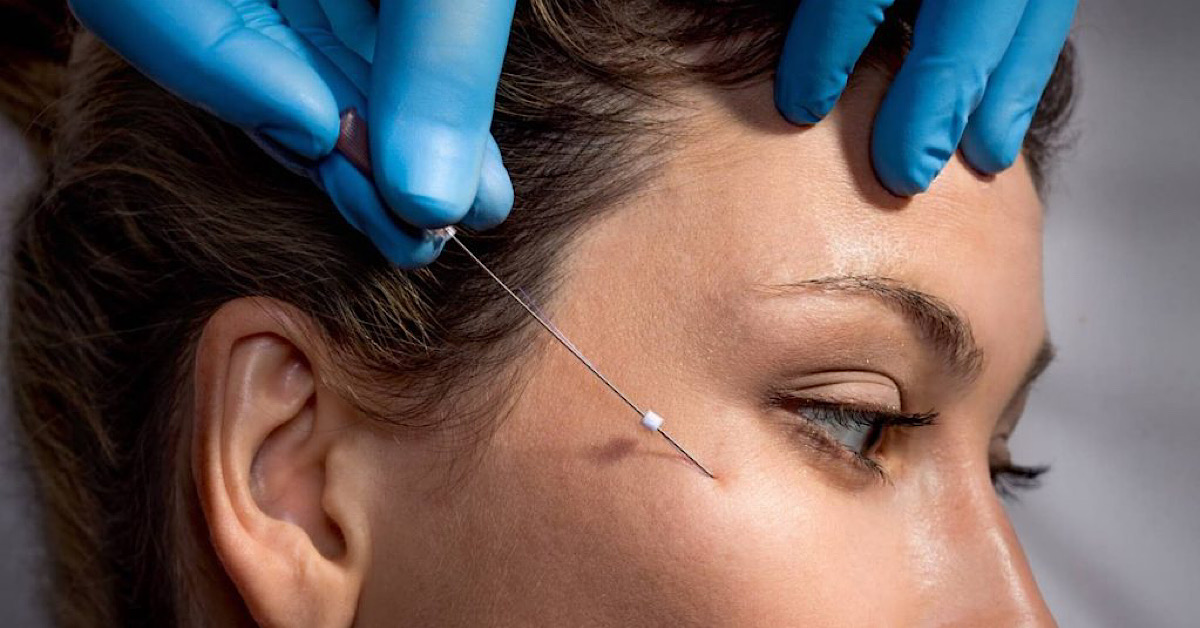 FIGO – Chỉ sinh học tự tiêu an toàn, hiệu quả