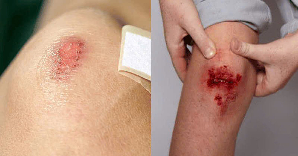 Nhiều người chăm sóc da sai cách sau điều trị hoặc sau phẫu thuật