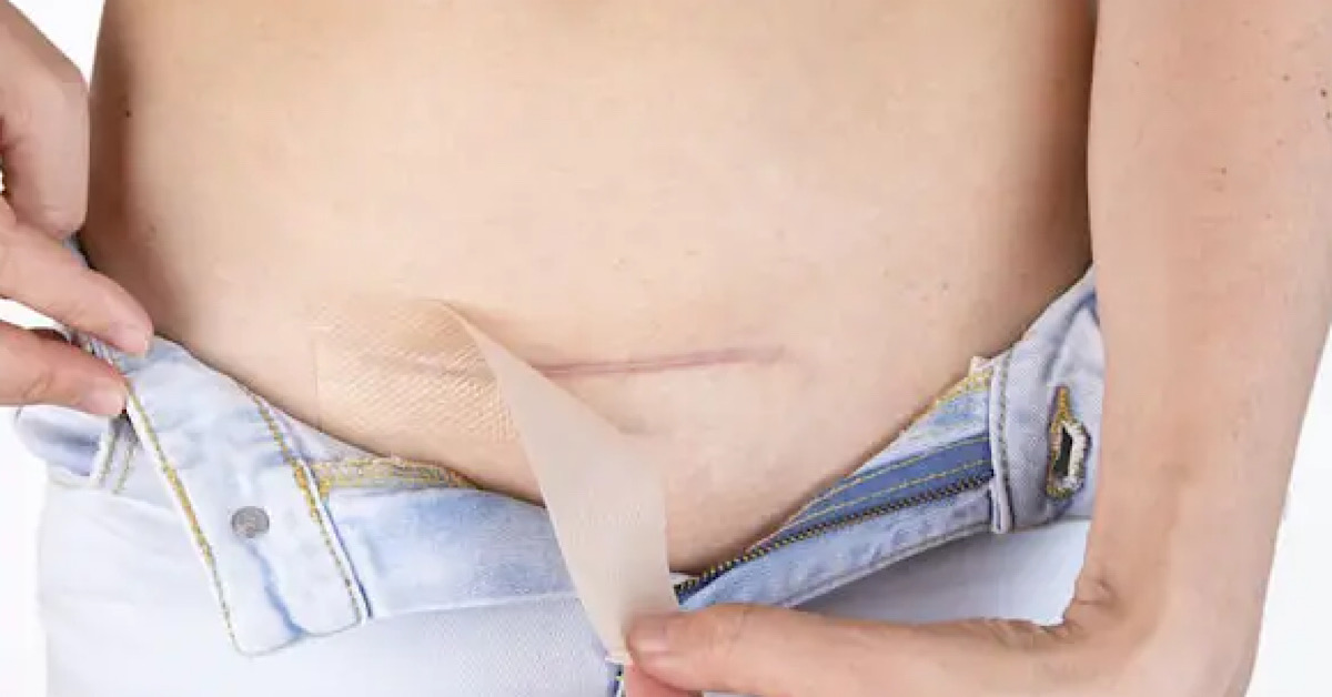 Amoena Curascar – miếng dán silicon y khoa dùng cho sẹo sau sinh mổ