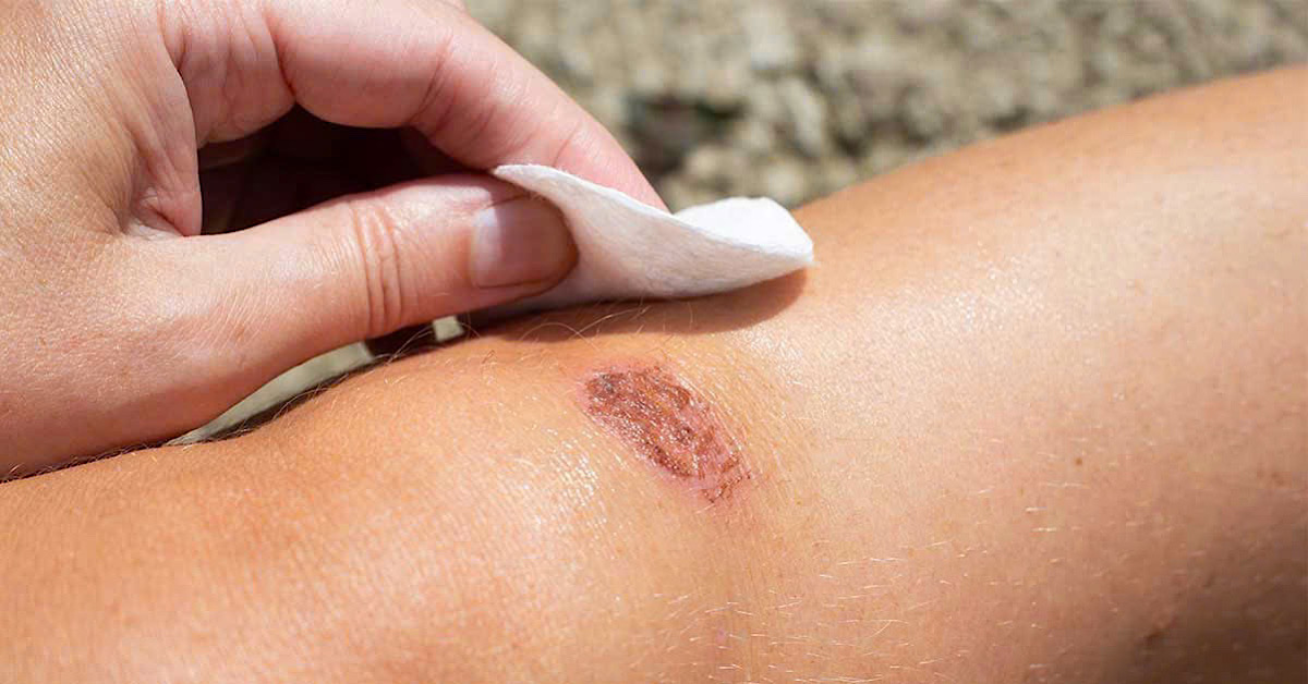 Làm sạch và bảo vệ da sẹo khó lành đúng cách giúp nhanh lành sẹo