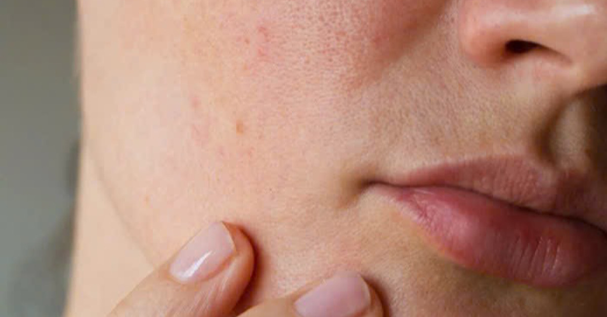 Làn da chảy xệ, lỗ chân lông to