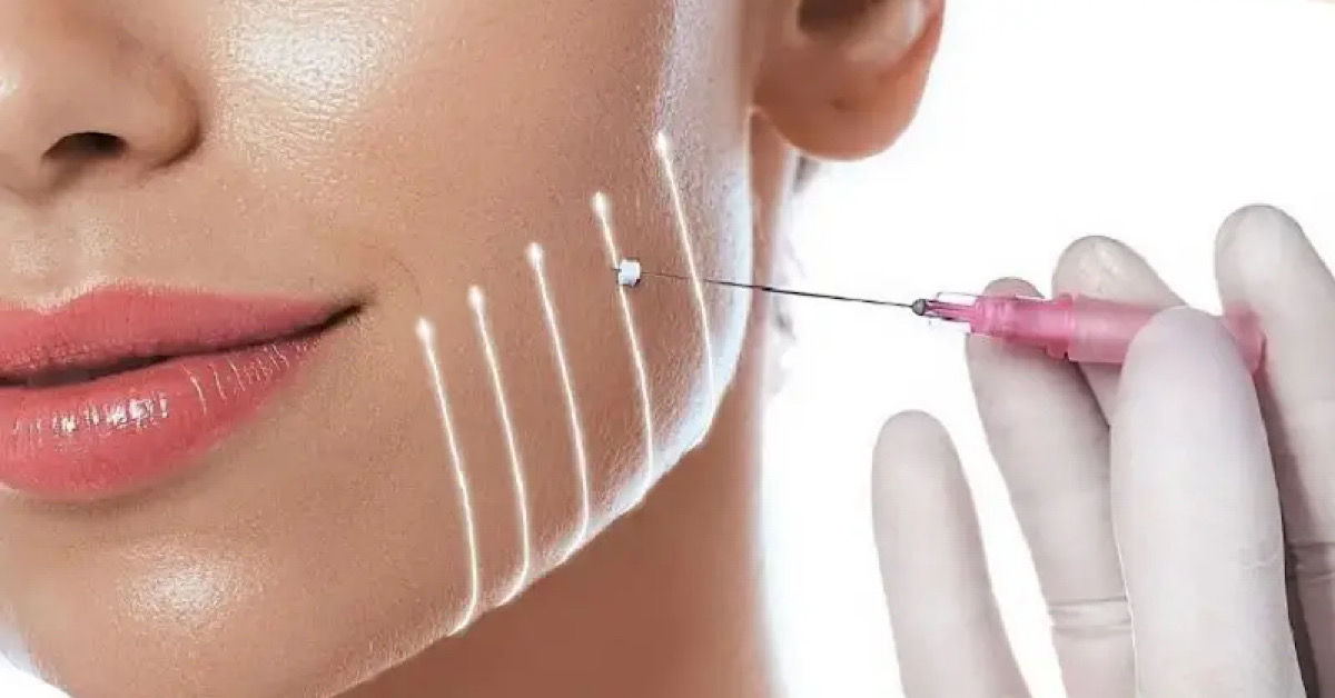 Chỉ FIGO giúp nâng cơ mặt tức thì