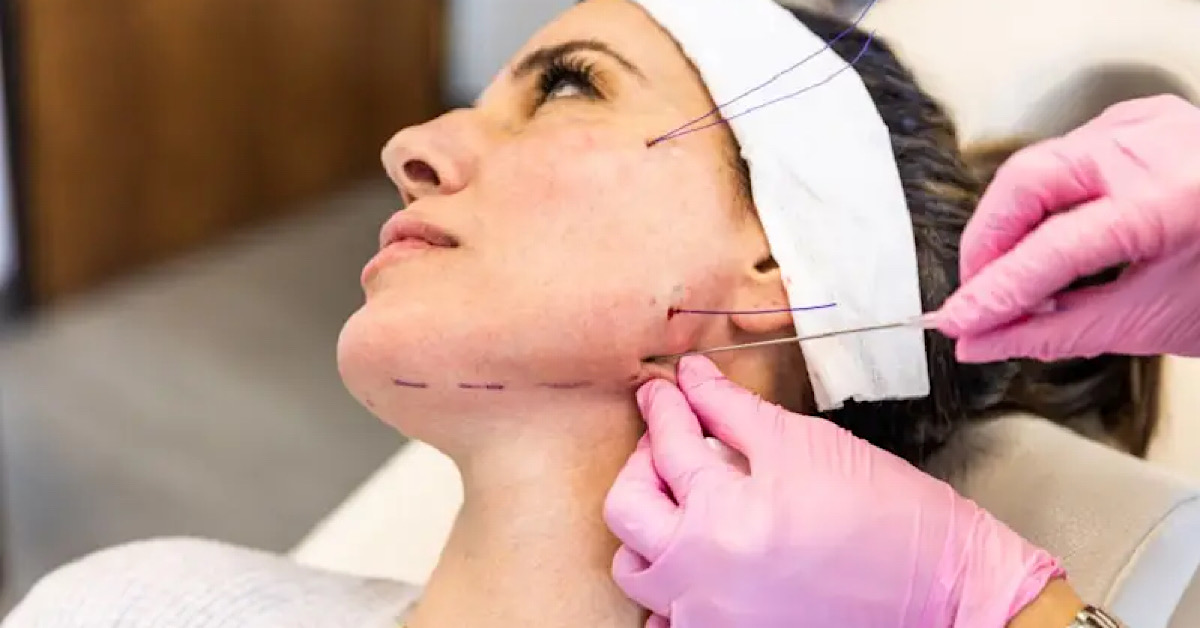 Chỉ FIGO – công cụ tạo hình, trẻ hoá toàn diện