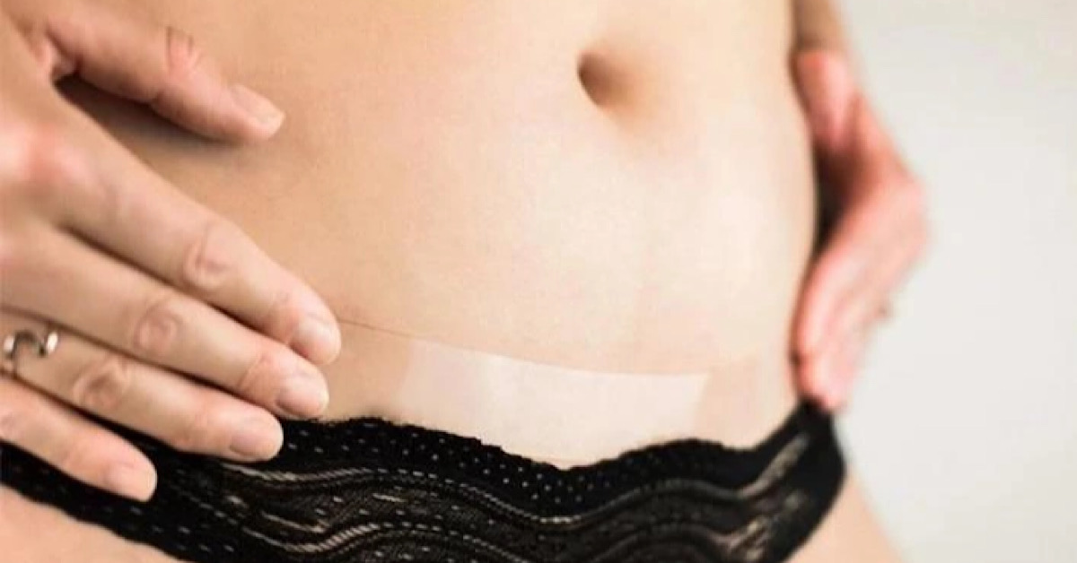 Kiên trì sử dụng Amoena Curascar để đạt hiệu quả tốt nhất