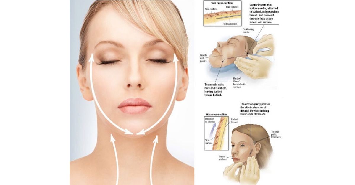 Cấy chỉ FIGO mang lại hiệu quả an toàn