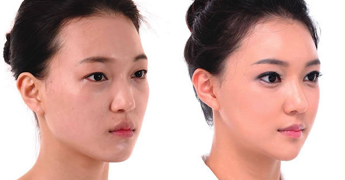 Chỉ FIGO tạo hình và làm đầy các vùng lõm