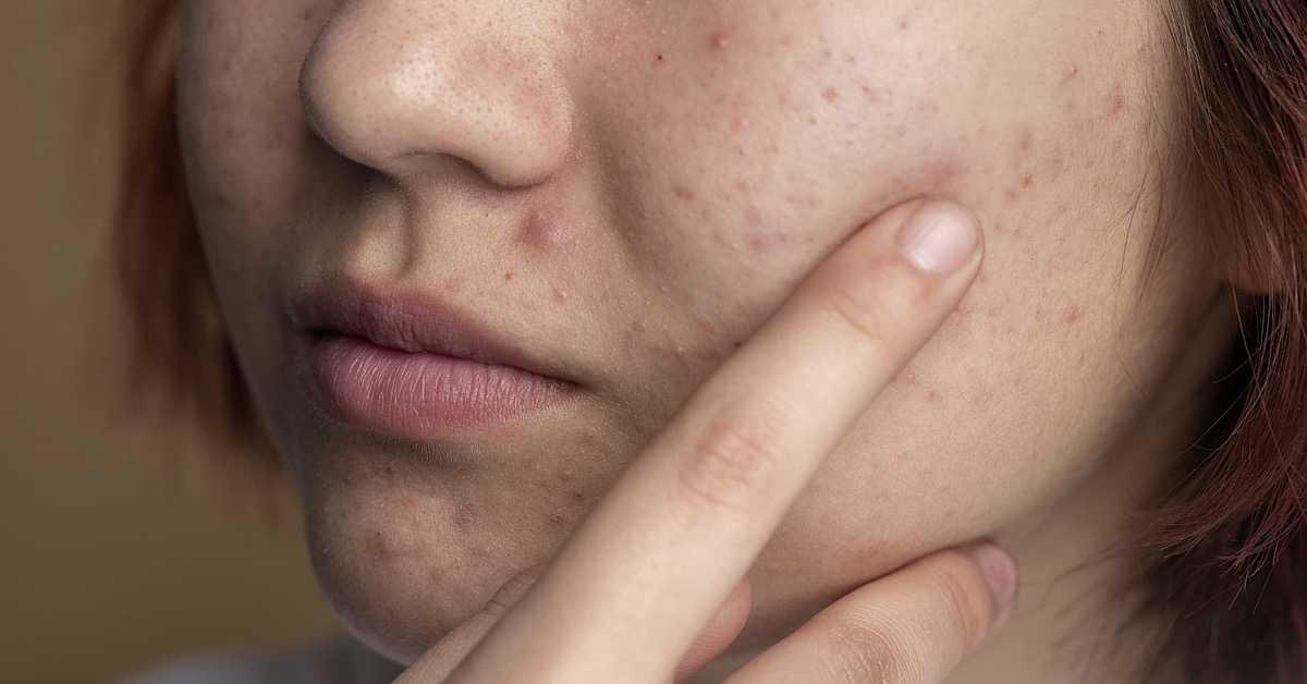 Làn da mỏng, yếu và dễ kích ứng