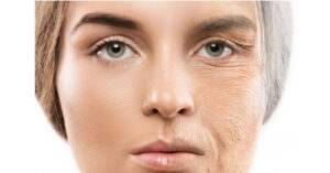 Rãnh cười ngày càng hằn sâu