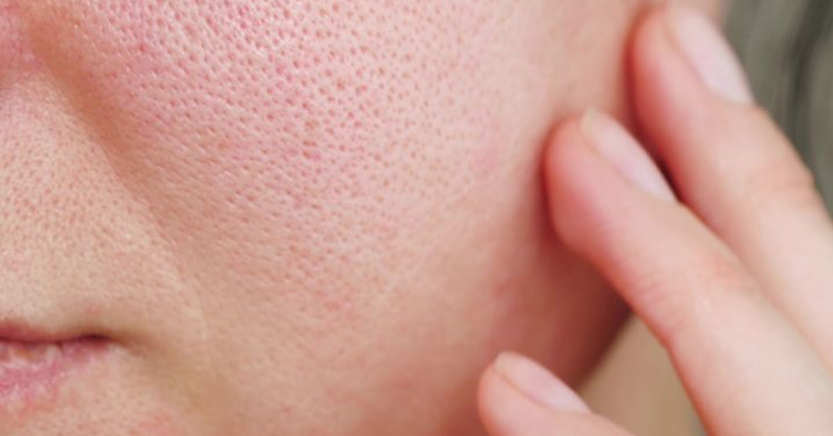 Lỗ chân lông to, mở rộng hình giọt nước