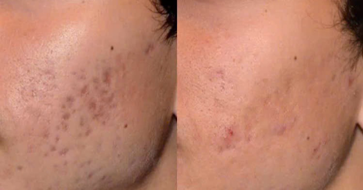 Lựa chọn phương pháp phù hợp để trị sẹo thâm một cách hiệu quả