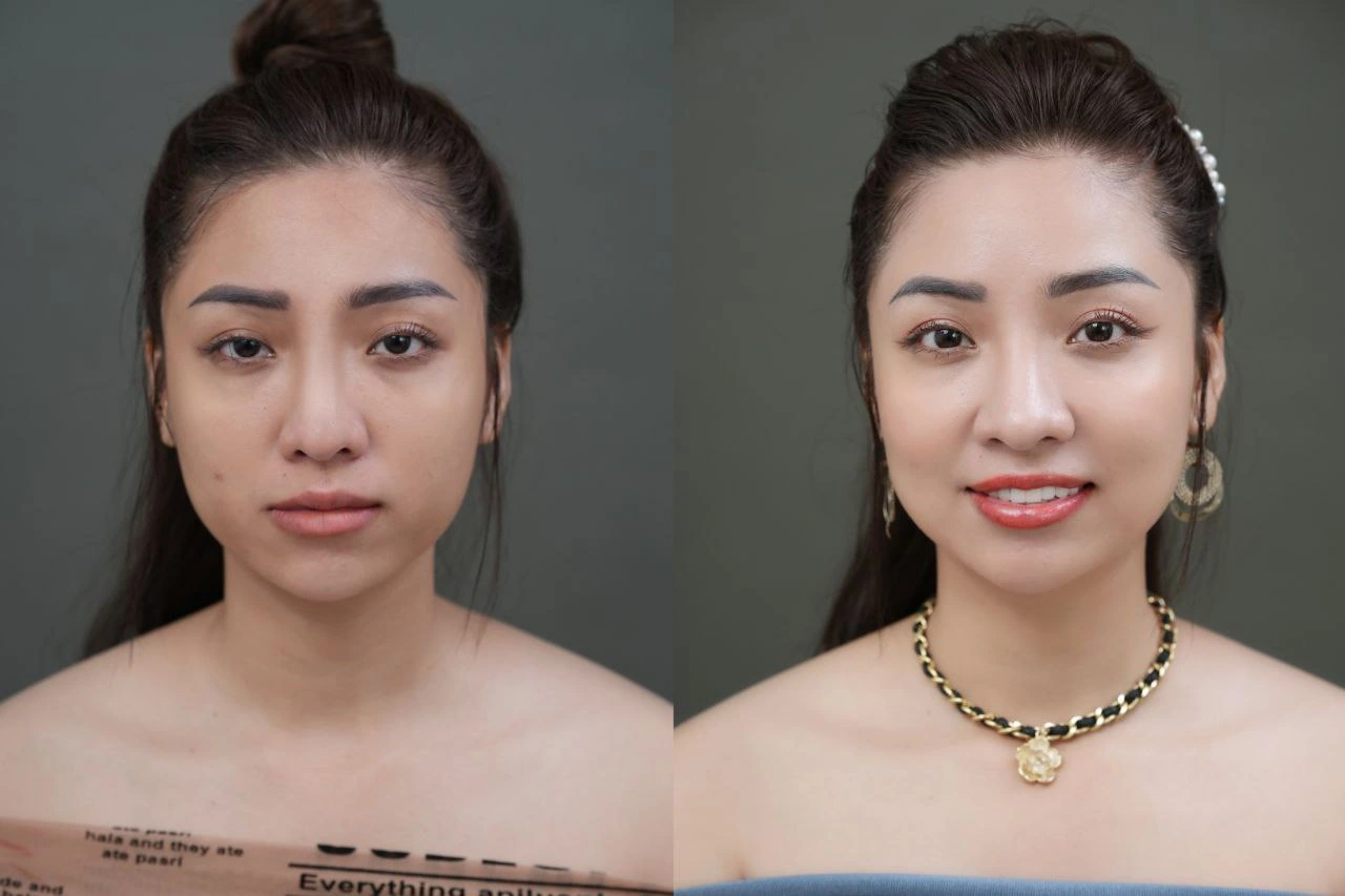 Da cải thiện rõ rệt nhờ Linerase Collagen