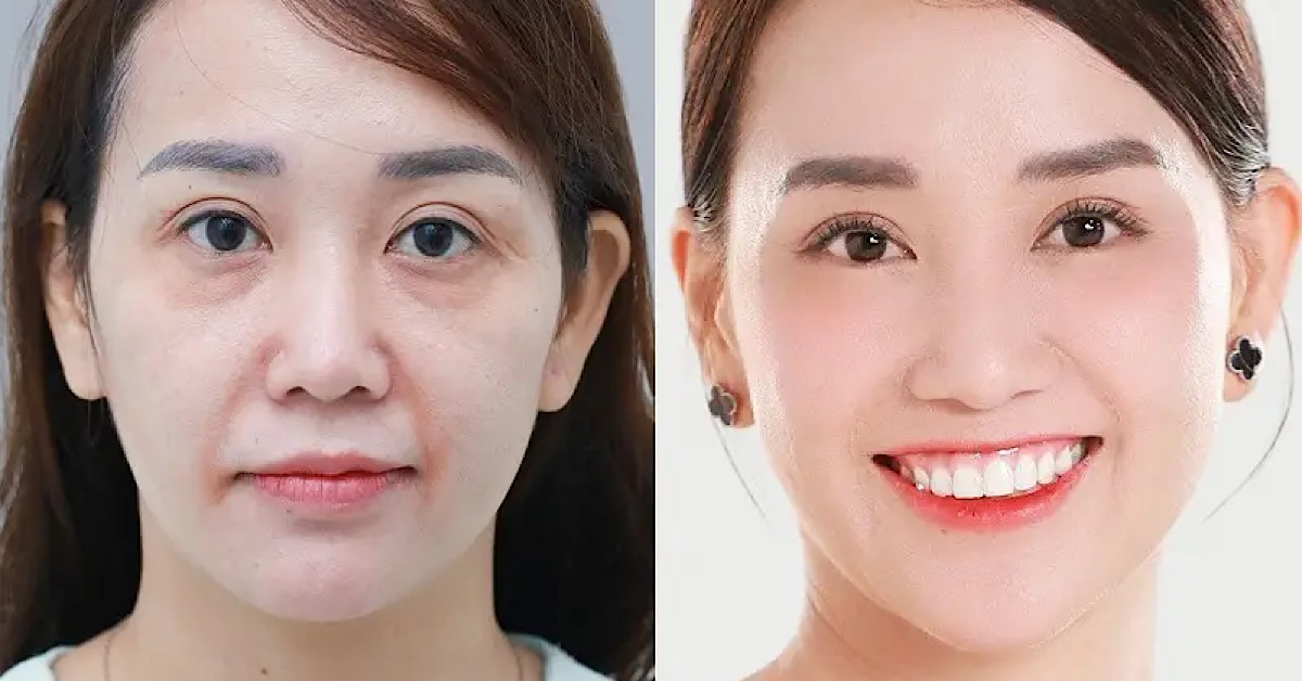 Nâng cơ bằng chỉ FIGO mang lại kết quả rõ rệt