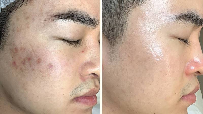 Trải nghiệm thực tế sau khi tiêm Linerase cho da nhạy cảm & da sau peel